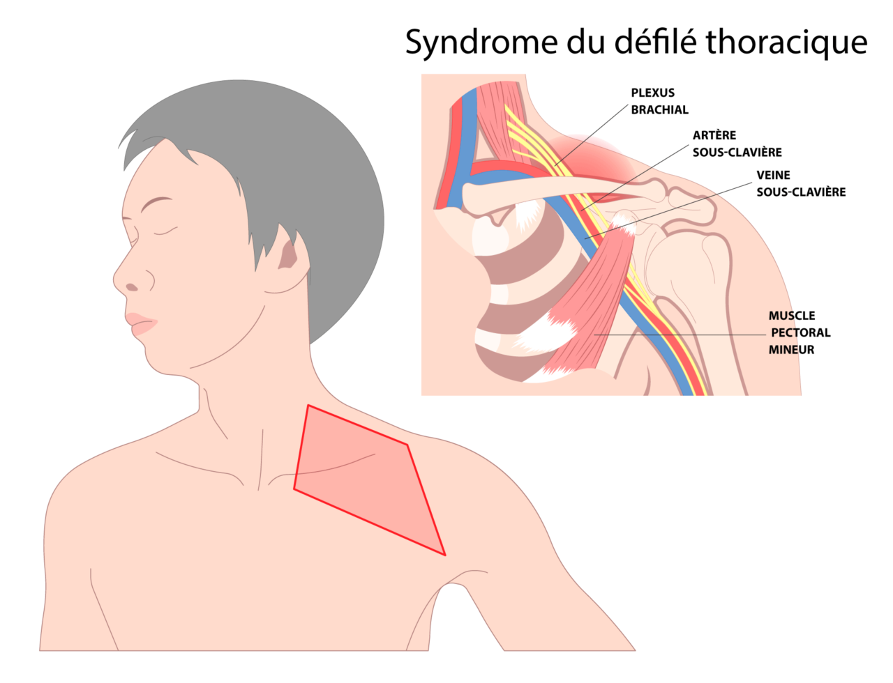 Syndrome Défilé Thoraco Brachial Etablir un diagnostic