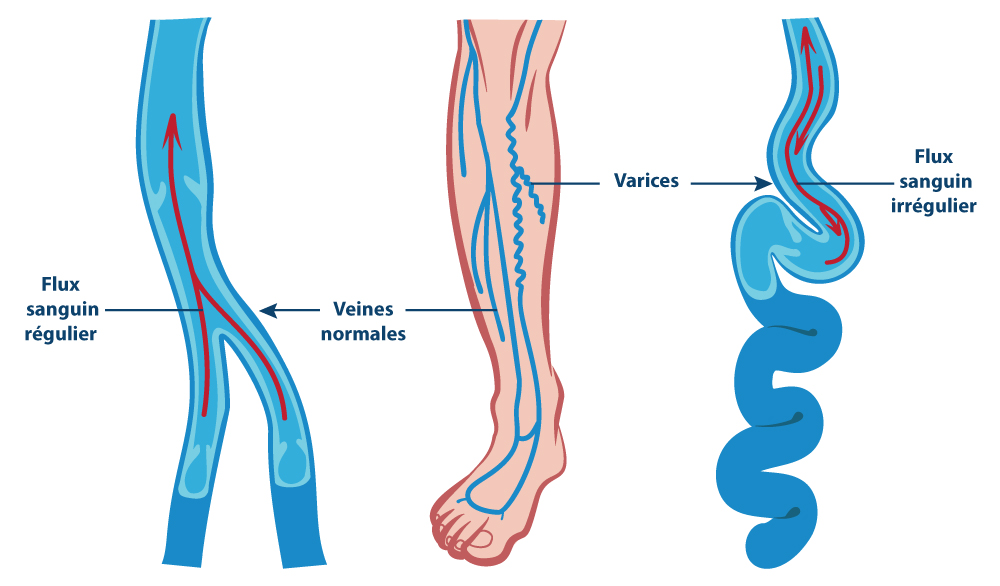 Varices des membres inférieurs : Anatomie et physiologie
