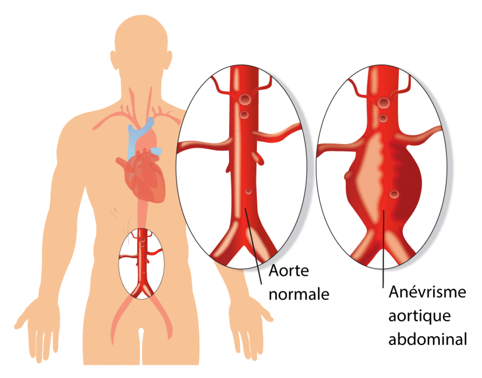 Quand traite-t-on un anévrysme abdominal aortique et iliaque