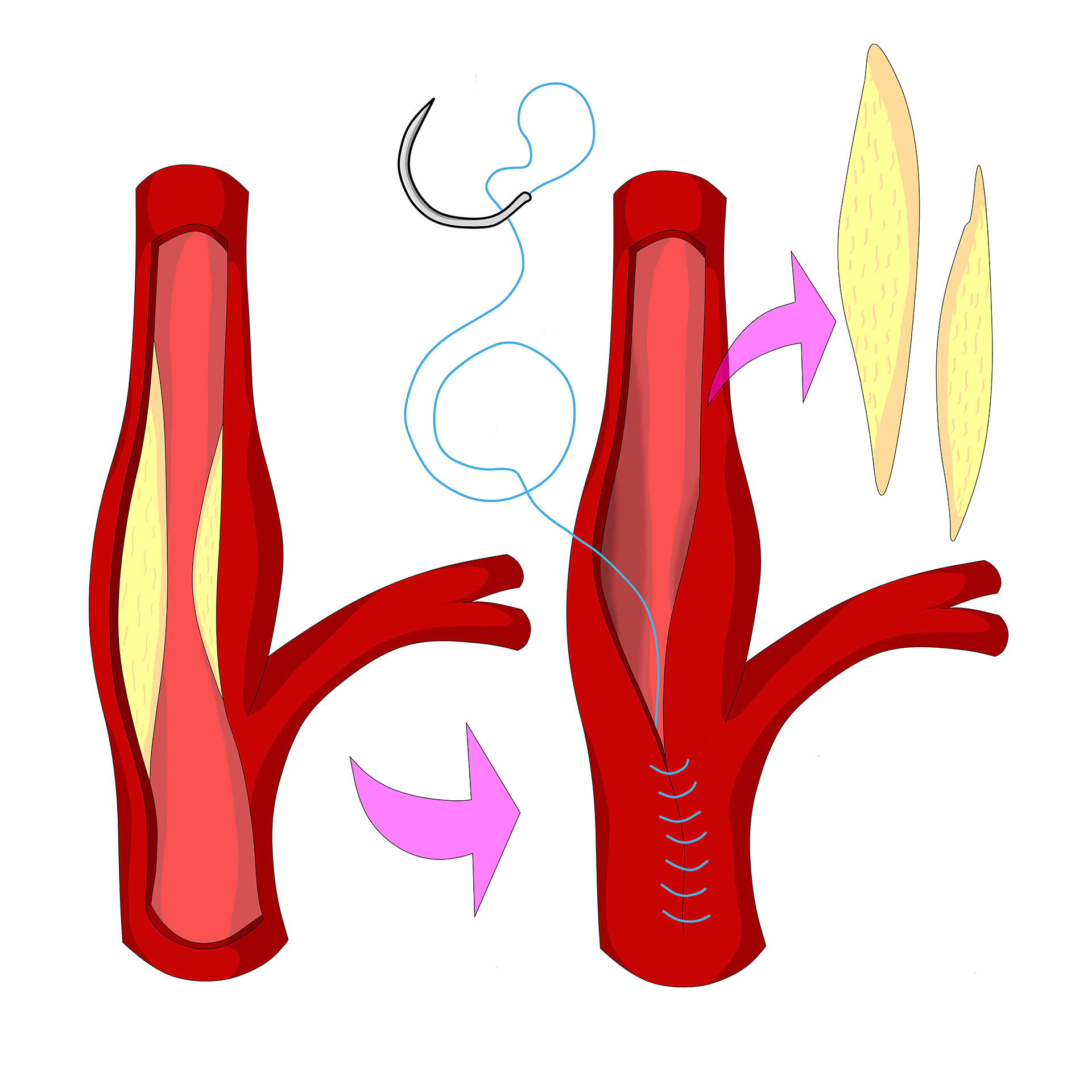 Sténose carotidienne : examen de l'artère carotide par doppler